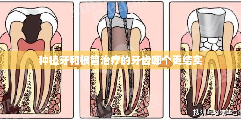 种植牙和根管治疗的牙齿哪个更结实