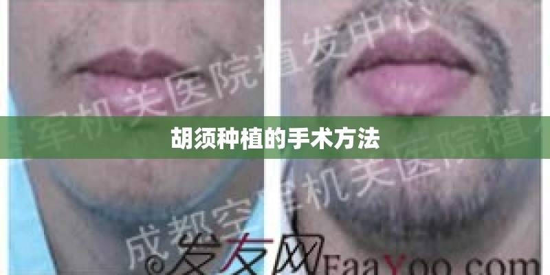 胡须种植的手术方法